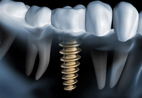Dental implants periodontist